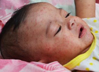 ΚΕΕΛΠΝΟ: «Η επιδημία ιλαράς δεν φαίνεται να σταματάει»