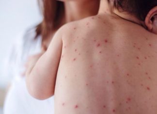 Προβληματισμός στο ΚΕΕΛΠΝΟ για τη συνεχιζόμενη επιδημία ιλαράς