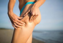 Η θεραπεία της κυτταρίτιδας