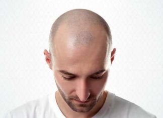 Δεκάδες χιλιάδες αιτήσεις για μεταμόσχευση μαλλιών στην Τουρκία