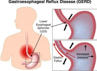 Τι είναι το ελικοβακτηρίδιο Πυλωρού – Θεραπεία